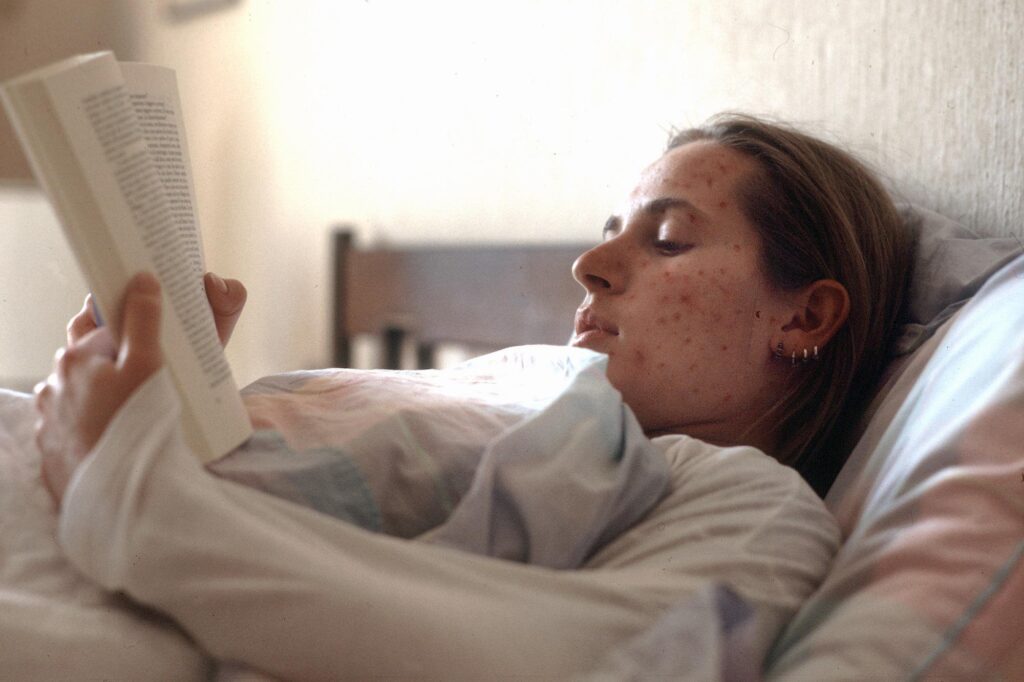 Rougeole, Nicastri (Spallanzani) : « Cas en augmentation chez les adultes, vaccin recommandé »