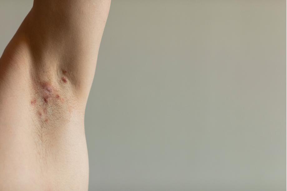 Médicaments, des études confirment l'efficacité monoclonale dans l'hidrosadénite suppurée