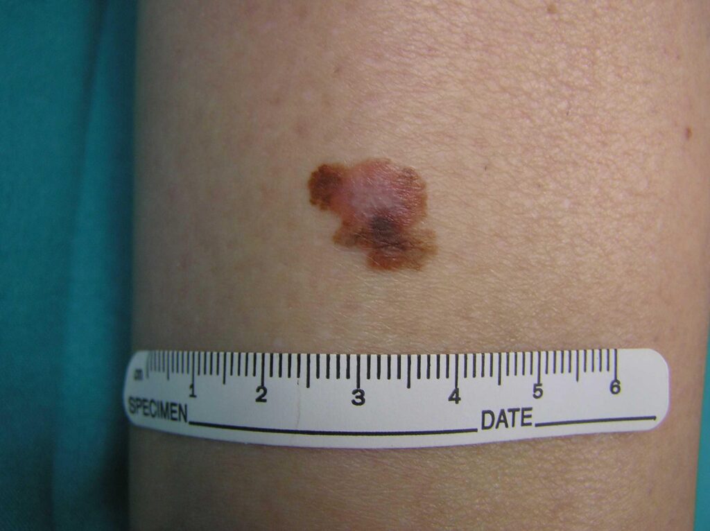 Cancer, oncologue : "Trois ans pour le vaccin à ARNm contre le mélanome"