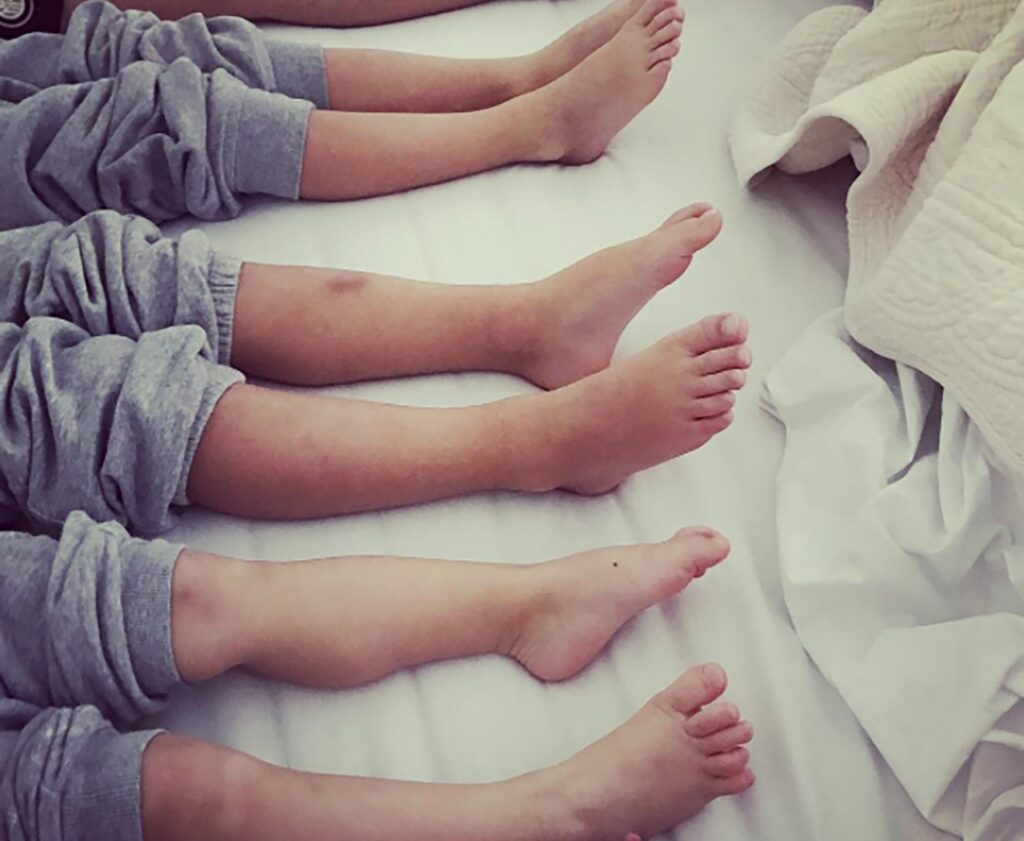 Du valgus du genou aux pieds plats, défauts chez les enfants : que faire et quand s'inquiéter