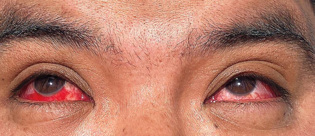 Grippe aviaire, voici les symptômes du premier homme infecté