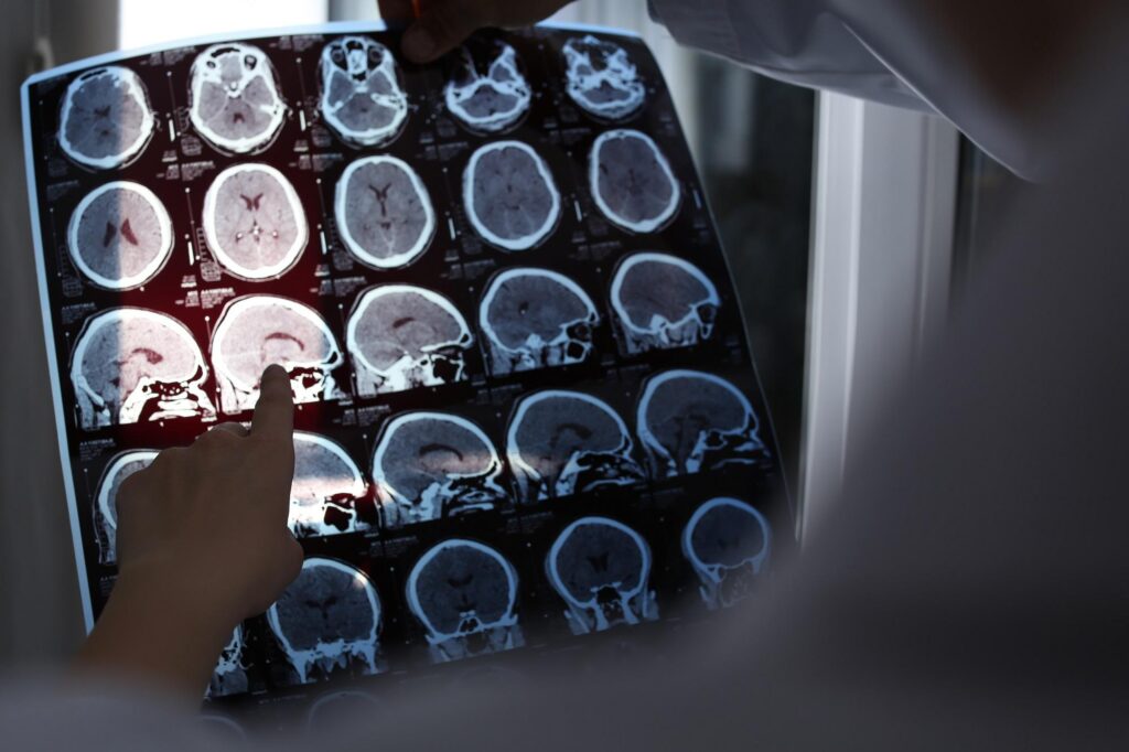 La maladie d'Alzheimer est-elle héréditaire ? Plus de risques si la mère en était atteinte : l'étude
