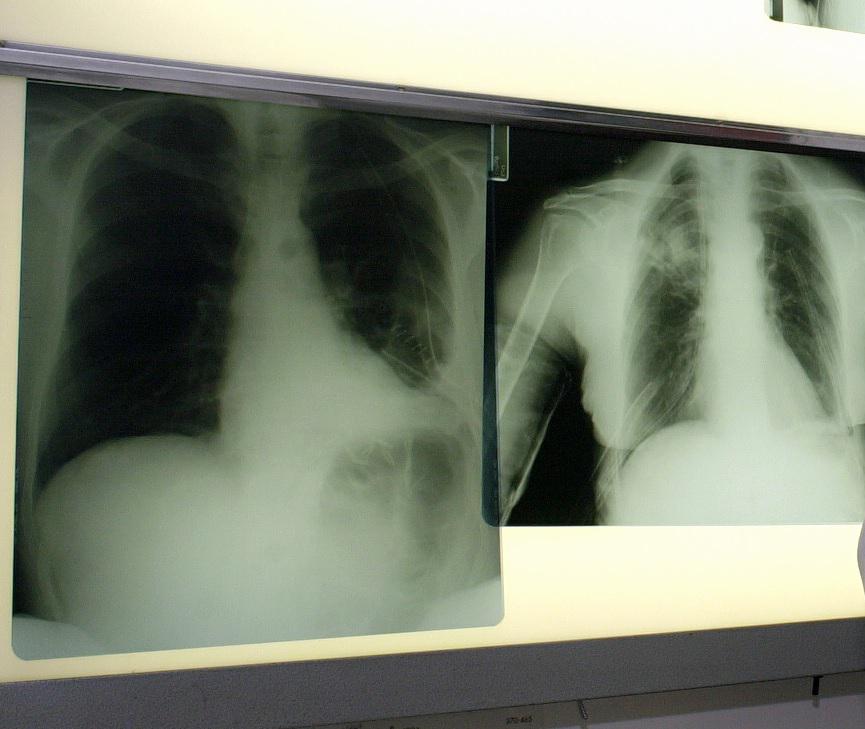 Cancer du poumon, Int et Politecnico Milano avec MSD pour innover dans la gestion des patients
