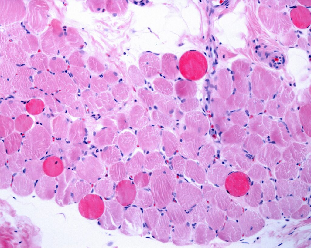 Dystrophie de Duchenne, méthode italienne pour réparer et régénérer les muscles