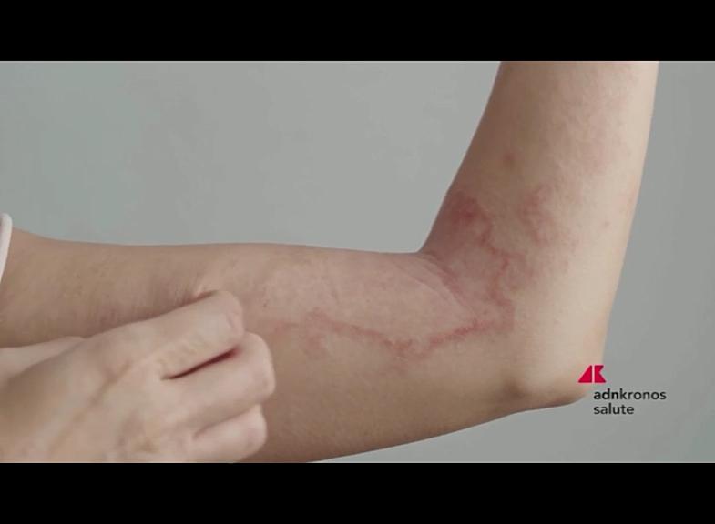 Psoriasis, feu vert de l'Aifa au remboursement du deucravacitinib pour les formes modérées et sévères