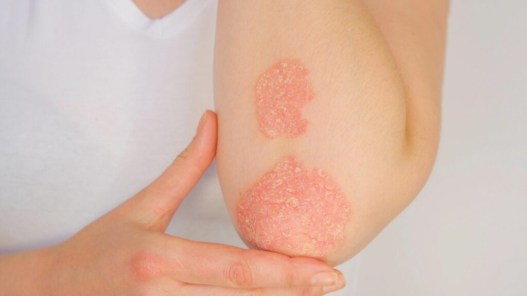 Psoriasis, la campagne « Une pause de dépistage en vaut la peine » démarre