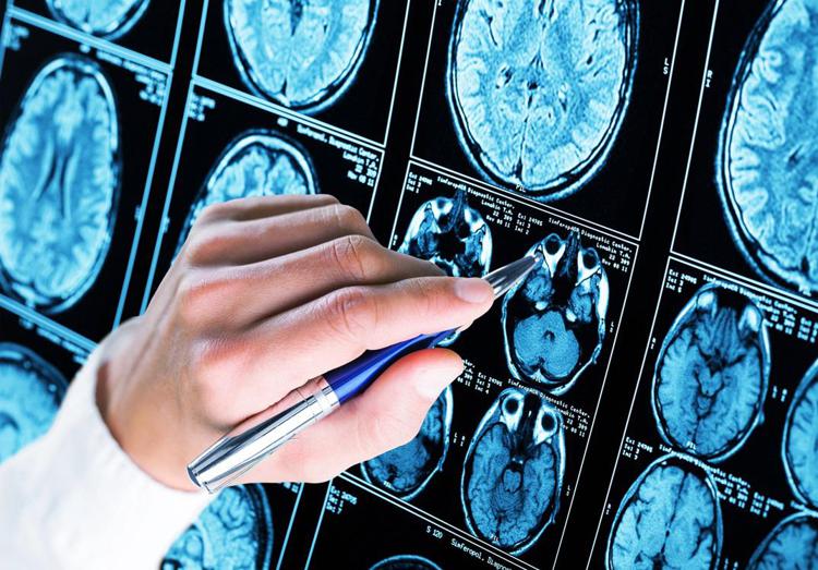 Médicaments, lécanemab : nouvelles données sur les bénéfices à long terme dans la maladie d'Alzheimer précoce