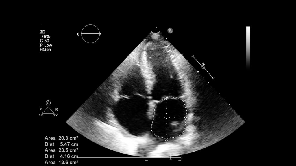Echographie pulmonaire, l'Italie à l'avant-garde avec de bonnes pratiques cliniques