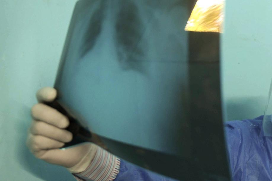 Selon l'enquête, 63 % des publications en ligne sur le cancer du poumon concernent les traitements.