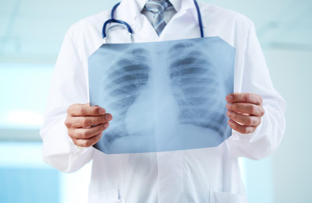 Adénocarcinome du poumon, carte d'identité du variant mucineux révélée