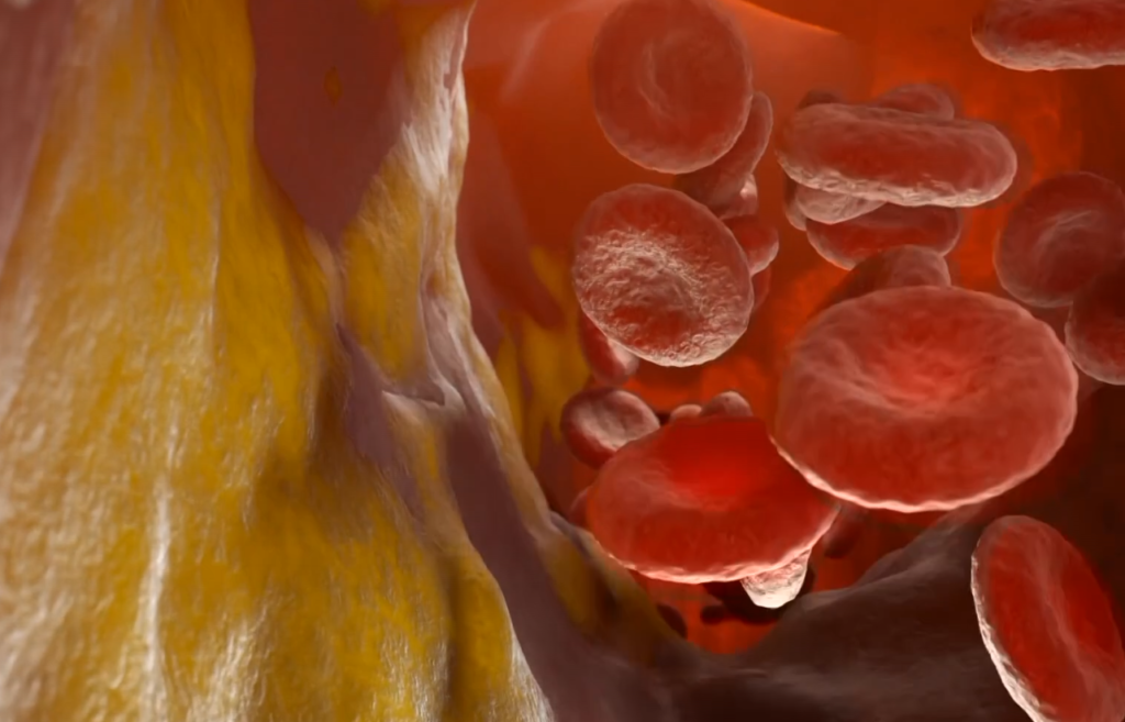 La thérapie à l'ARN réduit le cholestérol LDL de plus de 60 %, selon une étude italienne