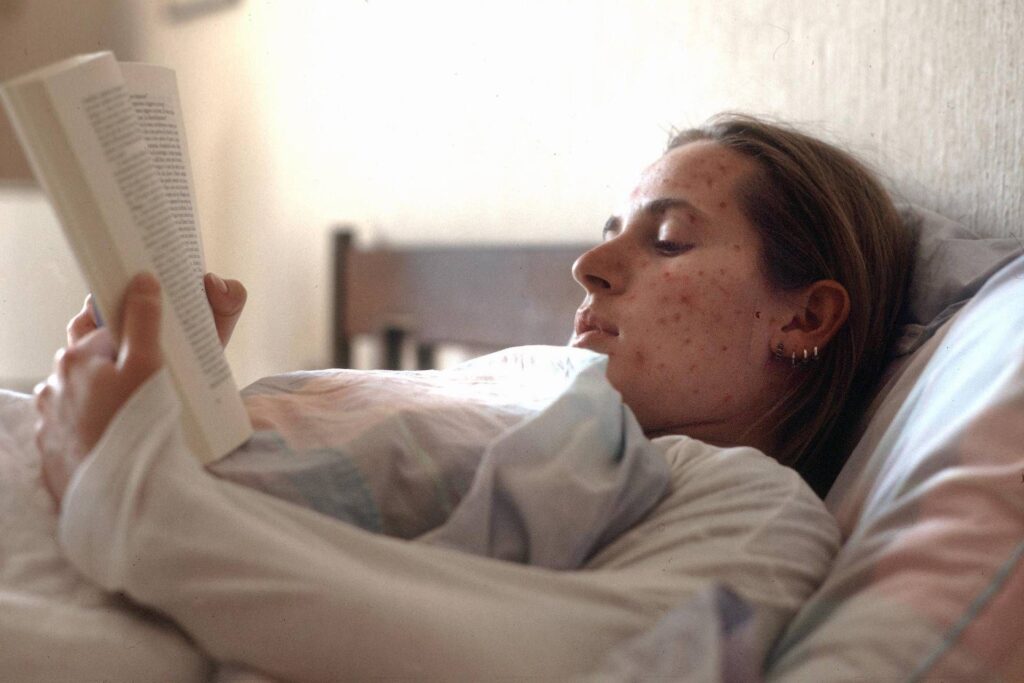 Morbillo, Record des cas en Europe: 127 350 en 2024, jamais autant en 25 ans