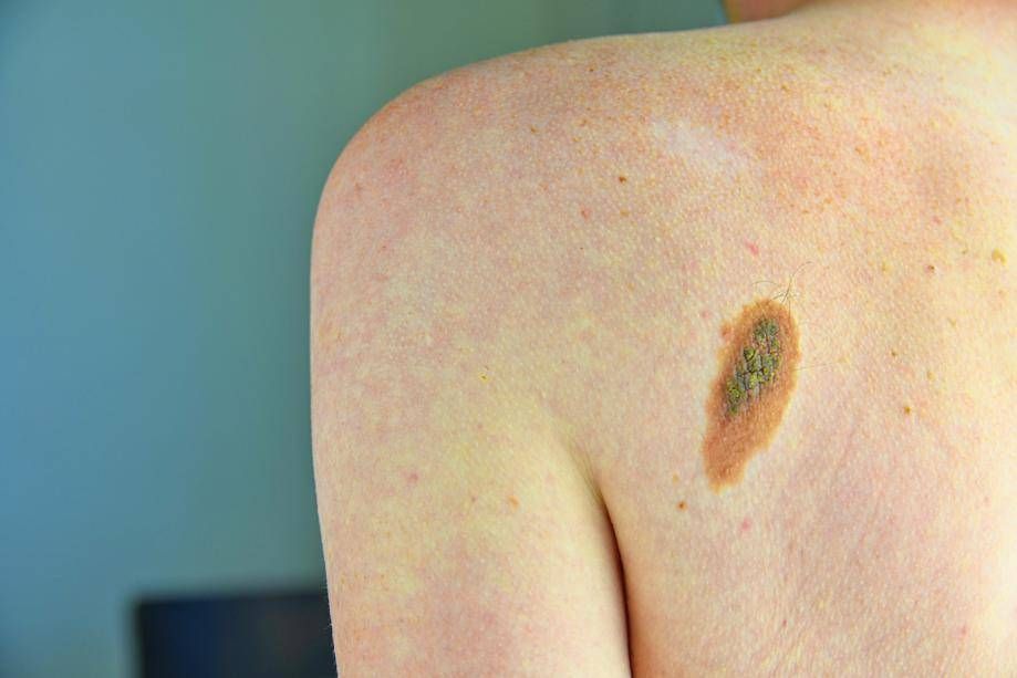 OK AIFA à une immunothérapie à phase précoce pour le mélanome et le cancer pulmonaire