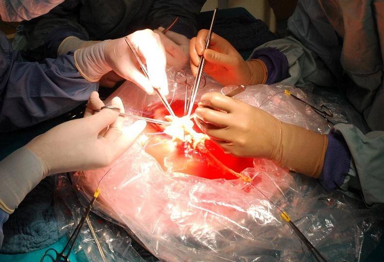 Des transplantations, à Padoue, ont planté le foie d'un enfant de 99 ans: le plus vieux donneur de tous les temps