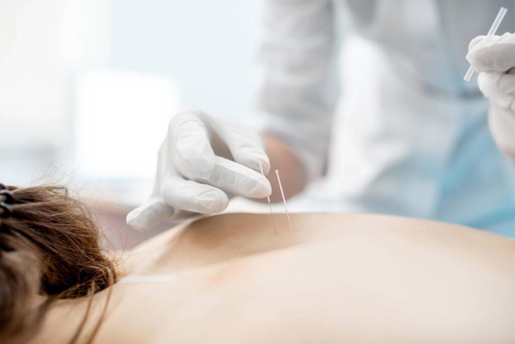 Entre les aiguilles et les neurones, «plus de 2 millions d'Italiens choisissent l'acupuncture»