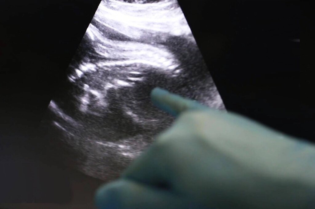 Transplant, Royaume-Uni, Amy First Child Né du don de l'utérus de la vie