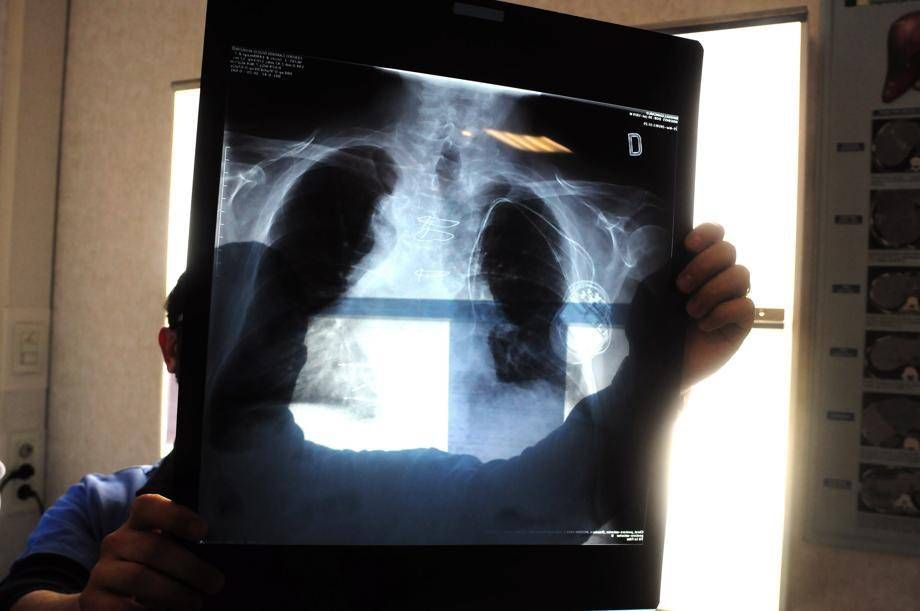 Tumeurs, dans le cancer pulmonaire, résulte des résultats positifs de la combinaison en première ligne