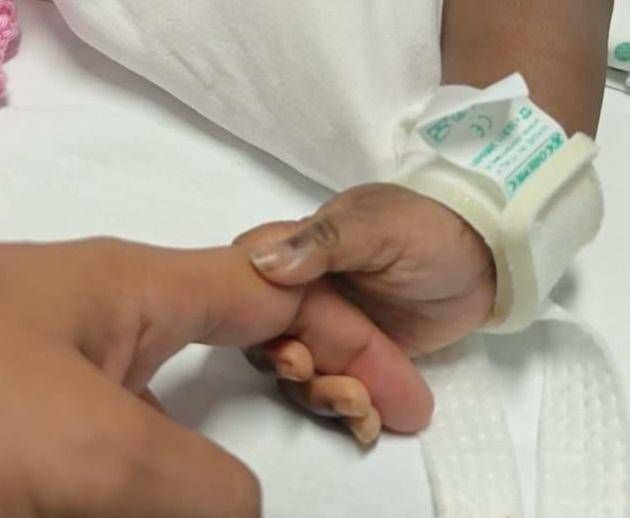 Des jumeaux siamois se sont séparés au Gaslini de Gênes: "Esubate, ils respirent seuls"