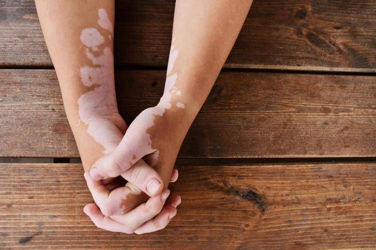 Été, vitiligo et soleil: les règles pour un bronzage sûr