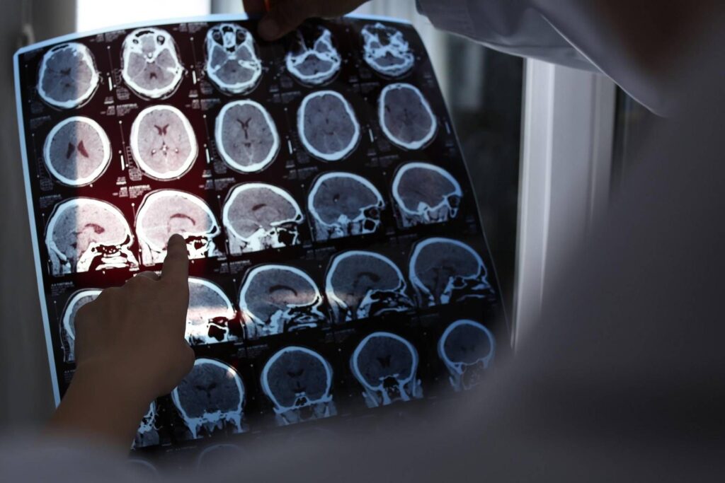 Alzheimer, ok ue un nouveau dévouement pour traiter la maladie des cœurs de départ