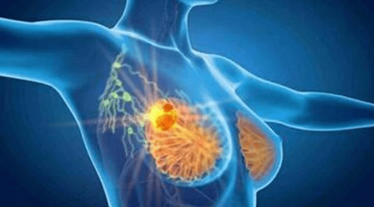 Le cancer du sein, grâce au profilage moléculaire et aux thérapies ciblées, de meilleures perspectives de guérison