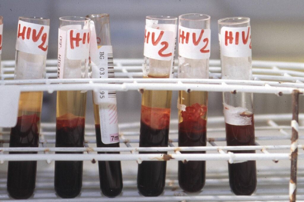 VIH, nouvelles données sur la PrEP deux fois par an et thérapies Gilead à l'Eacs 2025