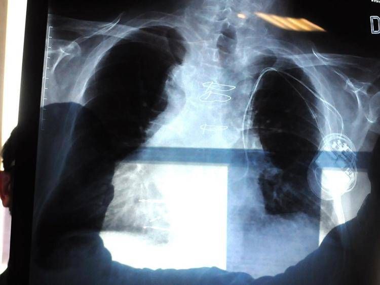 Pneumonie, chaque année en Italie 150 mille hospitalisations et 9 mille décès : les symptômes