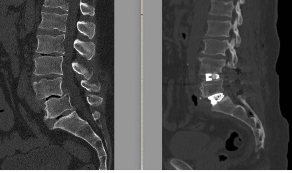 Chirurgie complexe de la colonne vertébrale, à l'hôpital de Tibériade à Rome, intervention avec la technique Alif