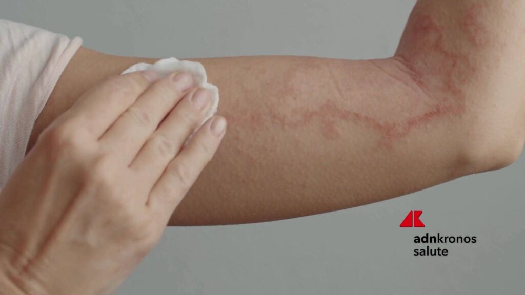 Le psoriasis pour 1,5 million d'Italiens, plus de 750 visites gratuites lors de la journée portes ouvertes nationale