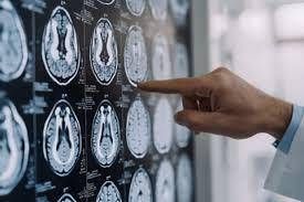 Arrêtez les tremblements de Parkinson sans scalpel, 10 patients traités par échographie à Naples