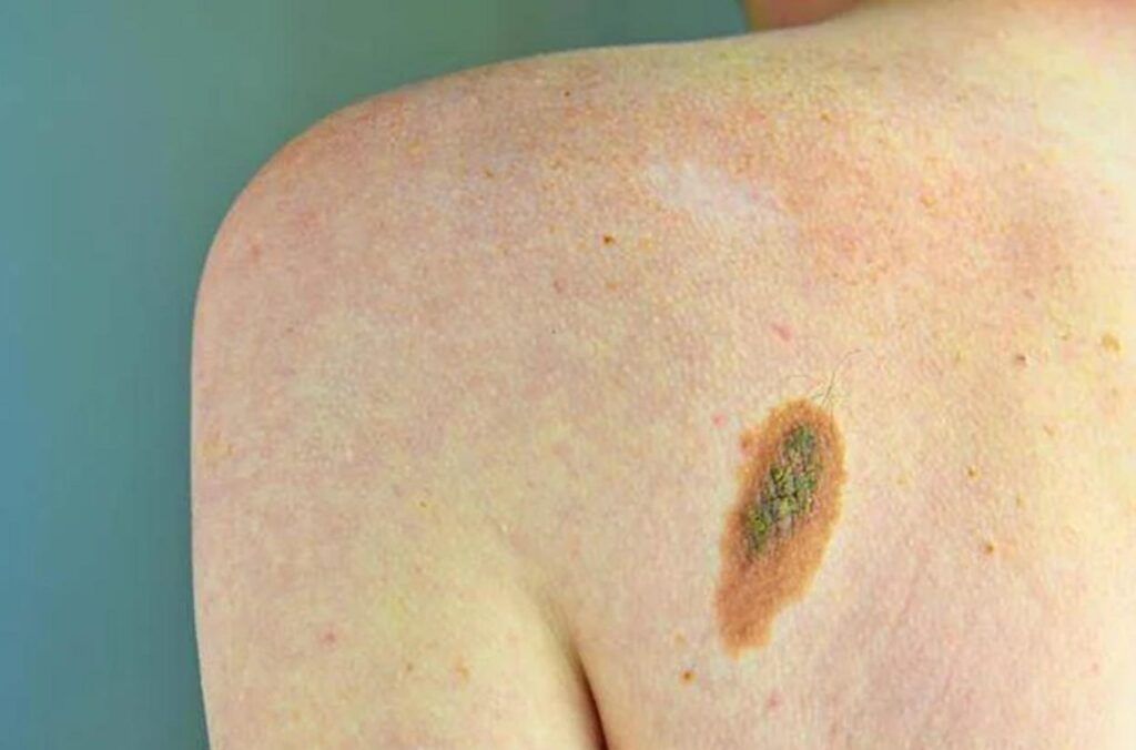 Mélanome, Adoi : « La nouvelle loi sur la prévention est bonne, dermatologue central en dépistage »