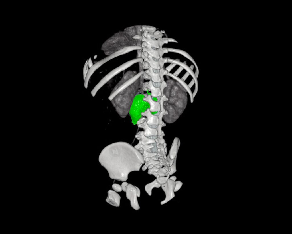Chirurgie sur mesure, neuroblastome complexe retiré chez une fillette de 1 an au Bambino Gesù de Rome
