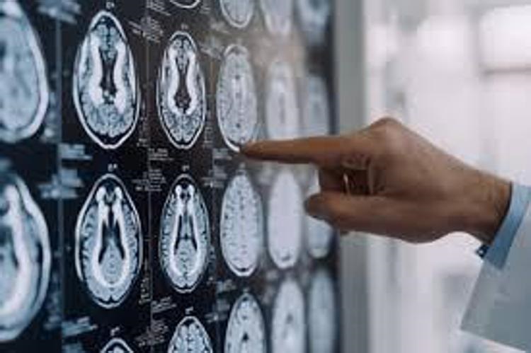 Maladie de Parkinson, formulation orale de Ld/Cd à libération modifiée autorisée en Europe