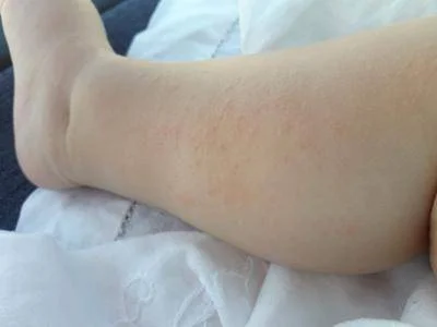 Dermatite atopique, l'Aifa étend le remboursement de l'upadacitinib à partir de 12 ans