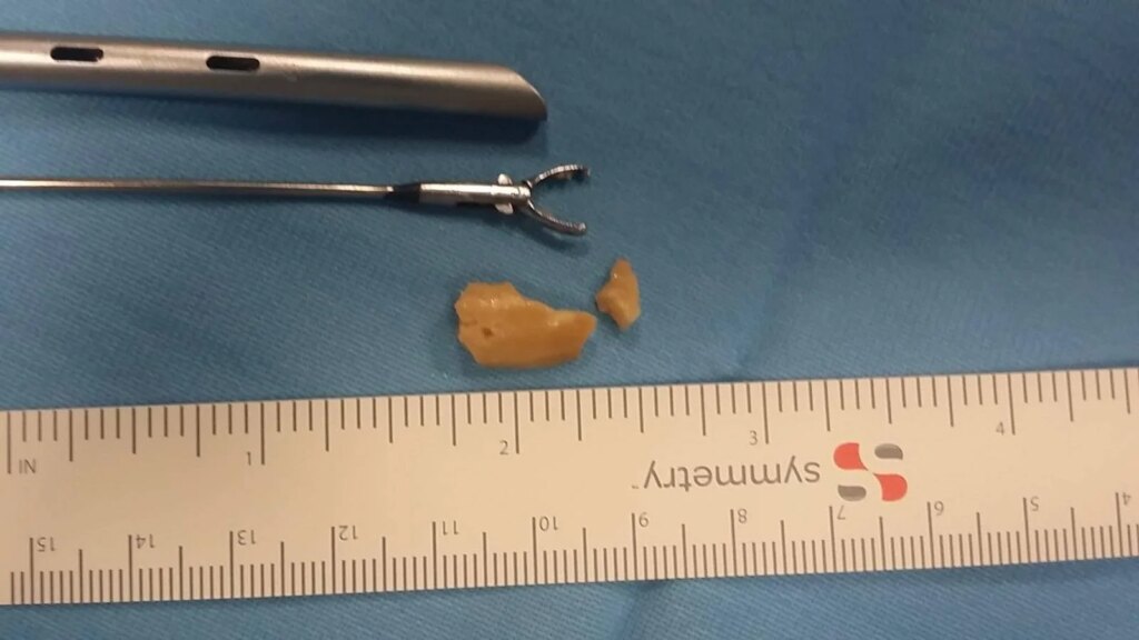 Elle avait une noisette coincée dans les bronches depuis deux semaines, sauvée à l'âge de 20 mois