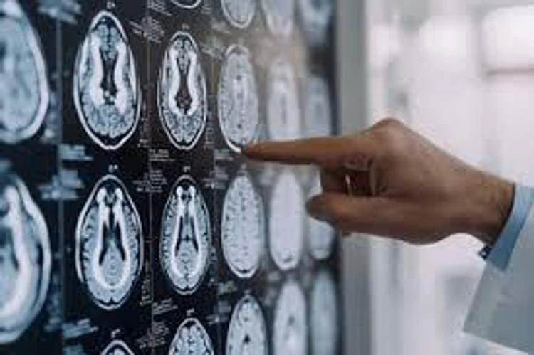 Maladie de Parkinson, en Italie, 300 000 personnes en souffrent : 10 % sont diagnostiquées avant l'âge de 50 ans