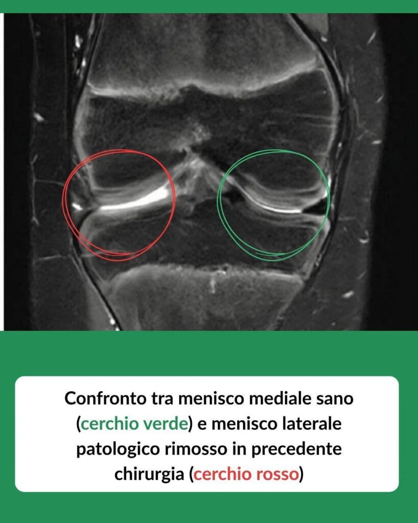 Marcher à nouveau grâce à une greffe : à 12 ans, il reçoit un ménisque d'un donneur décédé, chirurgie arthroscopique à Treviglio (BG)