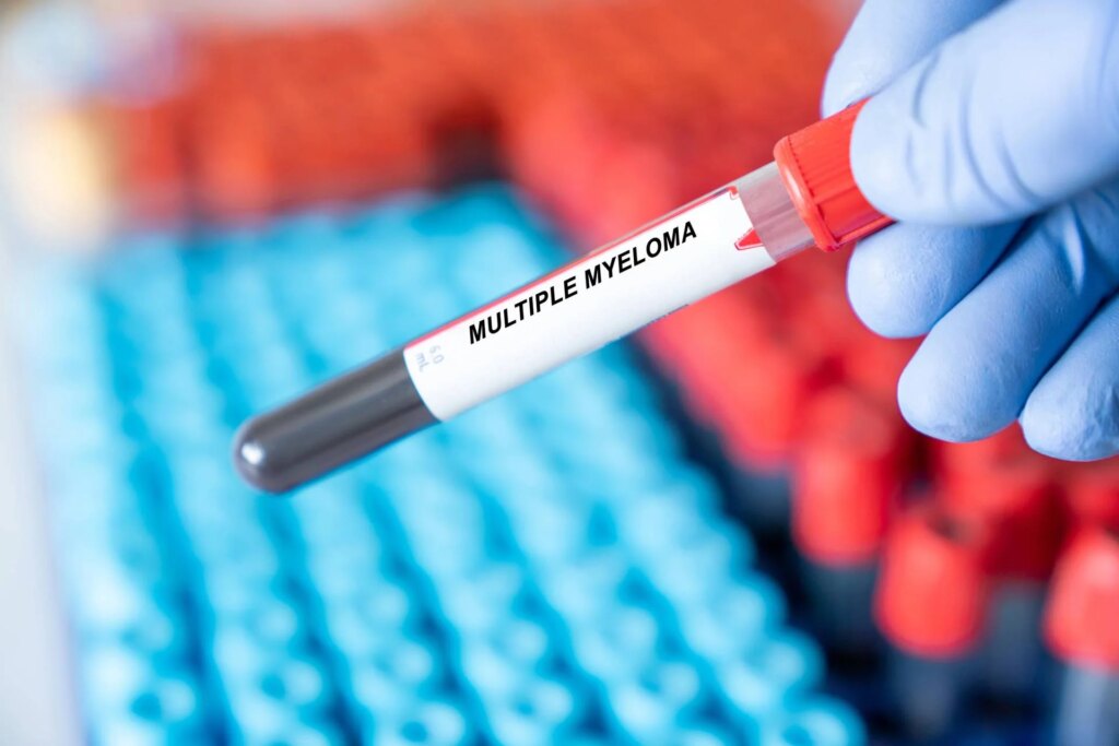 Myélome multiple, rémission de 5 ans avec thérapie Car-T cilta-cel dans les premières lignes