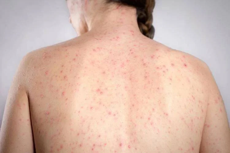 Rougeole, l'alarme de l'infectiologue Andreoni : « Cas en augmentation, hospitalisations fréquentes chez les adultes »