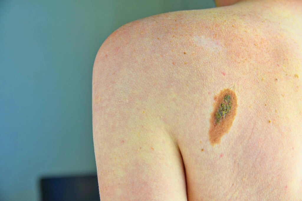 Le mélanome, la signature mutationnelle du cancer pourrait changer le traitement