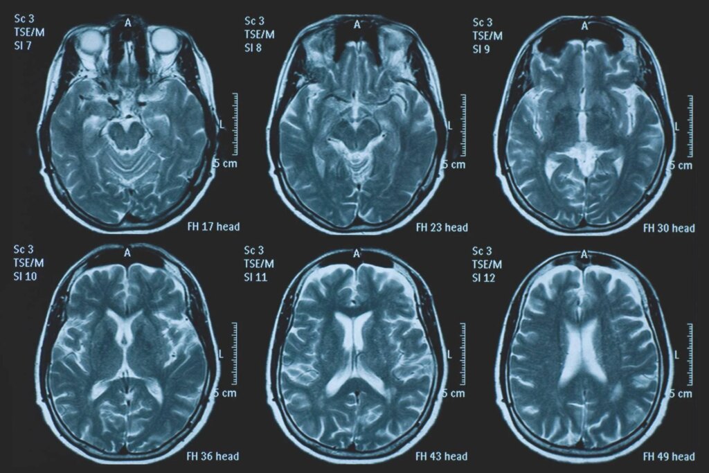 Une personne sur 3 souffre d'un trouble neurologique, BrainSpace House arrive à Naples